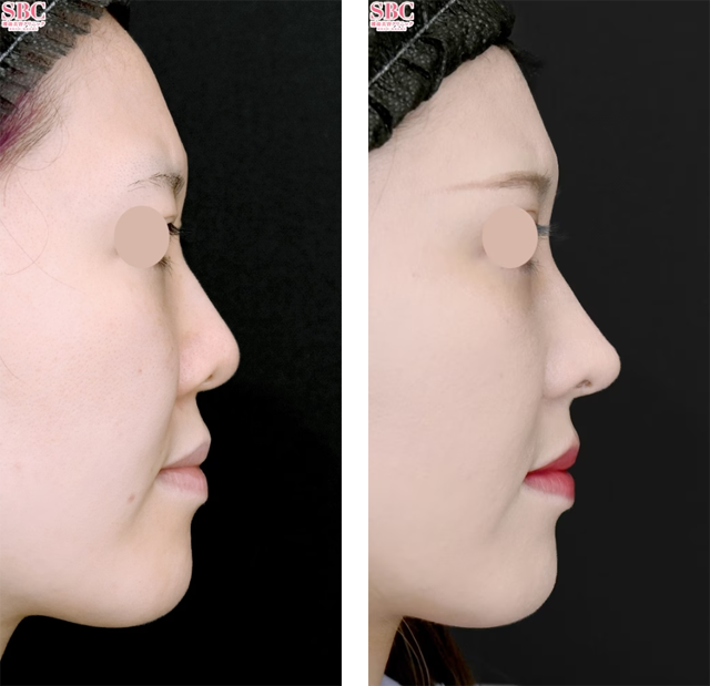 本間重行医師｜鼻尖形成3D法、鼻尖部耳介軟骨移植、鼻中隔延長(鼻中隔軟骨)、小鼻縮小（内側法＋締め付け縫合）｜施術前後の症例写真