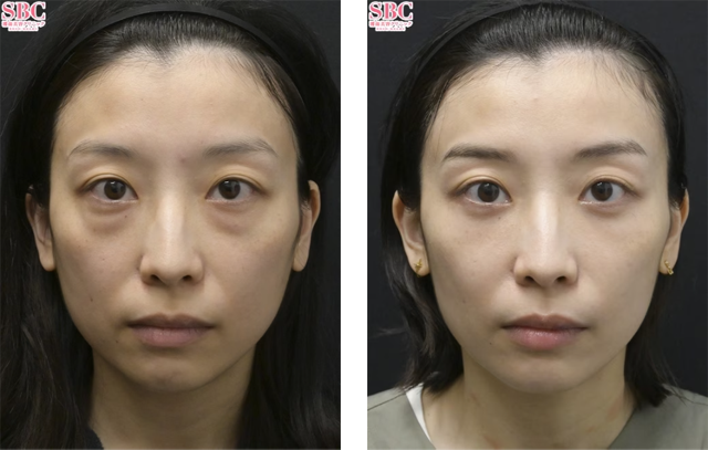 中谷拓医師｜目の下の切らないクマ・たるみ（ふくらみ）取り、ナチュラル脂肪注射コンデンスリッチ、ナチュラル脂肪注射ナノリッチ｜施術前後の症例写真