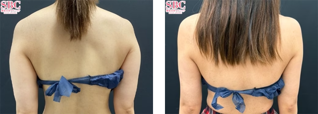 多田彩子医師｜Aquicell（アキーセル）脂肪吸引、根こそぎVASER脂肪吸引｜施術前後の症例写真