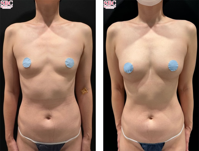 宜保智樹医師｜VASER併用コンデンスリッチ(脂肪注入豊胸)｜施術前後の症例写真