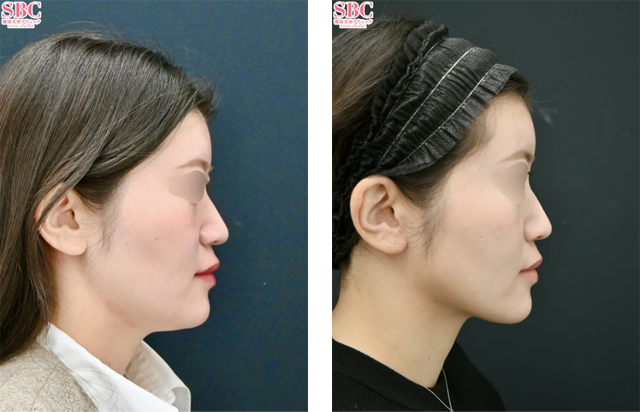藤巻直人医師｜根こそぎVASER脂肪吸引、エンブレイスRF｜施術前後の症例写真