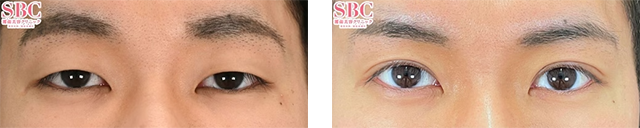 岩本優輝医師｜タルミ取り併用全切開法二重｜施術前後の症例写真