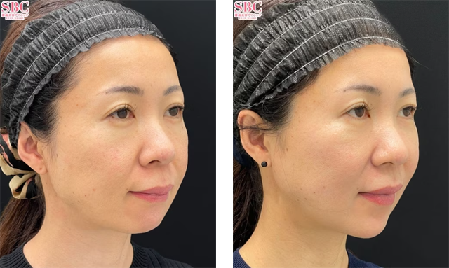 進藤彰人医師｜シークレットリフト、VOV（ボブ）リフト、テスリフト｜施術前後の症例写真