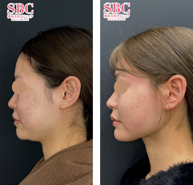 塩入幹汰医師｜美ボディ脂肪吸引｜施術前後の症例写真