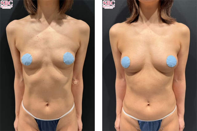 宜保智樹医師|コンデンスリッチ(脂肪注入豊胸)、VASER併用コンデンスリッチ(脂肪注入豊胸)|施術前後の症例写真