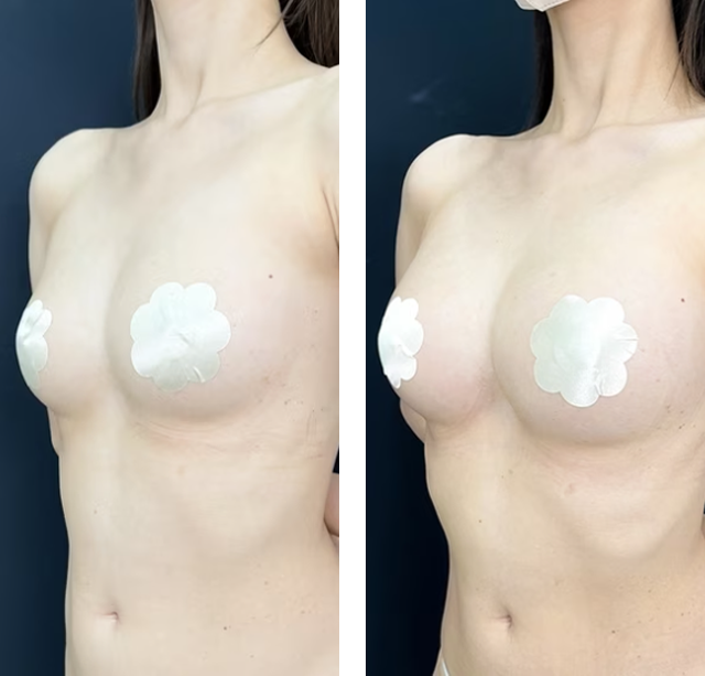 藤井里奈医師|コンデンスリッチ(脂肪注入豊胸)、コールマン式|施術前後の症例写真