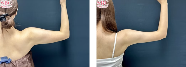 大須直人医師｜根こそぎVASER脂肪吸引｜施術前後の症例写真