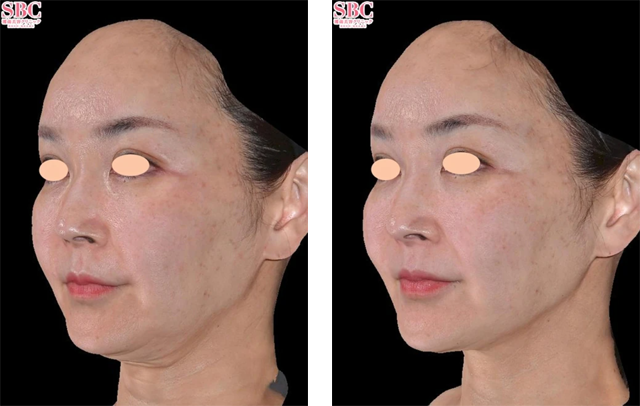西川礼華医師｜ウルトラリフトプラスHIFU、デンシティ（DENSITY）｜施術前後の症例写真