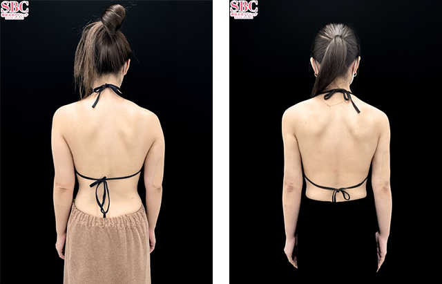 大川隆一朗医師｜根こそぎVASER脂肪吸引｜施術前後の症例写真