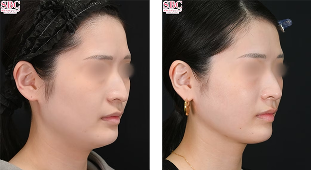河邉護医師｜美ボディ脂肪吸引｜施術前後の症例写真