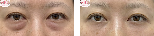 坂本龍亮医師｜目の下の切らないクマ・たるみ（ふくらみ）取り、ナチュラル脂肪注射｜施術前後の症例写真