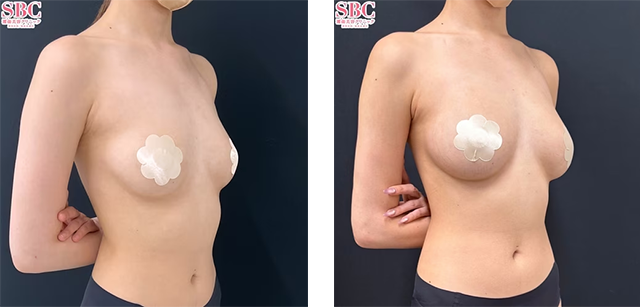 大谷悠輔 医師|Aquicell(アキーセル)併用コンデンスリッチ(脂肪注入豊胸)|施術前後の症例写真