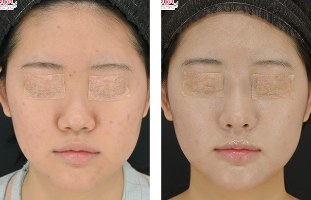 居川和広医師｜肋軟骨鼻翼基部移植、鼻中隔延長術（肋軟骨）、鼻尖形成/鼻尖形成3D法（だんご鼻解消術）｜施術前後の症例写真