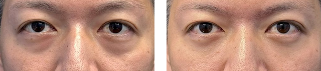 岩本理雨医師｜裏ハムラ法、ナチュラル脂肪注射ナノリッチ｜施術前後の症例写真