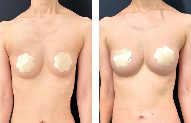 大谷悠輔 医師|コンデンスリッチ(脂肪注入豊胸)、コールマン式|施術前後の症例写真