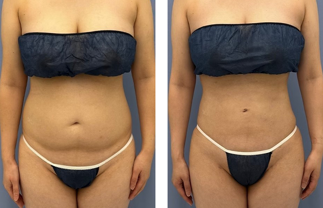 葛島魁人医師｜根こそぎVASER脂肪吸引、Aquicell（アキーセル）脂肪吸引｜施術前後の症例写真