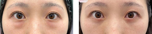 櫻井将継医師｜裏ハムラ法｜施術前後の症例写真