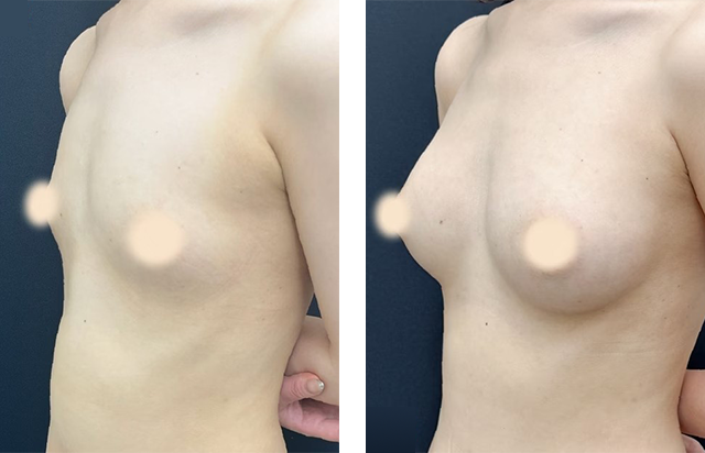 飯田誠丈 医師|Aquicell(アキーセル)併用コンデンスリッチ(脂肪注入豊胸)、コンデンスリッチ(脂肪注入豊胸)2回目|施術前後の症例写真