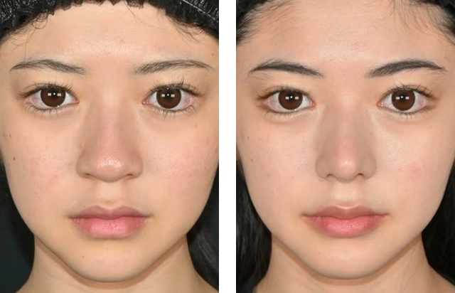 中野達生医師｜鼻尖形成/鼻尖形成3D法（だんご鼻解消術）、鼻尖部軟骨移植、小鼻縮小（フラップ＋外側法）｜施術前後の症例写真