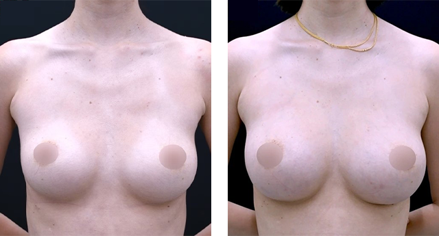 梶山典彦医師|コンデンスリッチ(脂肪注入豊胸)、Aquicell(アキーセル)併用コンデンスリッチ(脂肪注入豊胸)、コールマン式|施術前後の症例写真