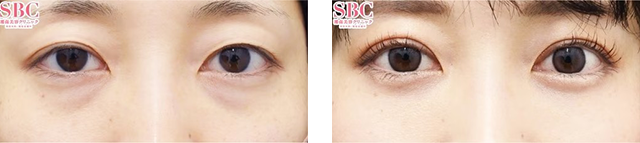 中谷拓医師｜裏ハムラ法｜施術前後の症例写真