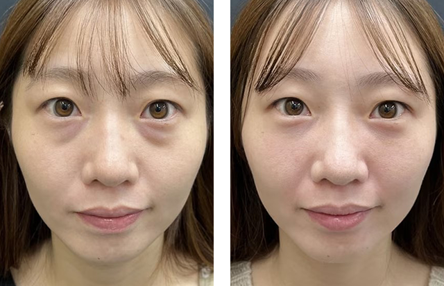 櫻井将継医師｜裏ハムラ法｜施術前後の症例写真