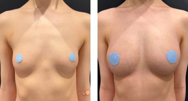 宜保智樹医師|コンデンスリッチ(脂肪注入豊胸)|施術前後の症例写真