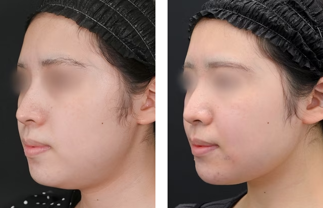河邉護医師｜美ボディ脂肪吸引｜施術前後の症例写真