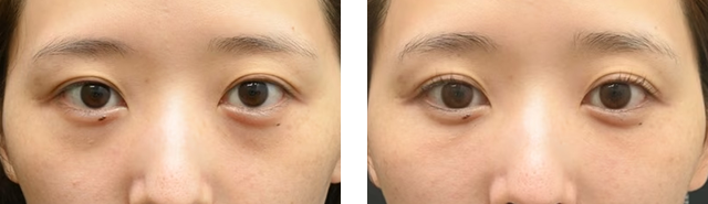 上田将士医師｜目の下の切らないクマ・たるみ（ふくらみ）取り、ナチュラル脂肪注射コンデンスリッチ、ナチュラル脂肪注射ナノリッチ｜施術前後の症例写真