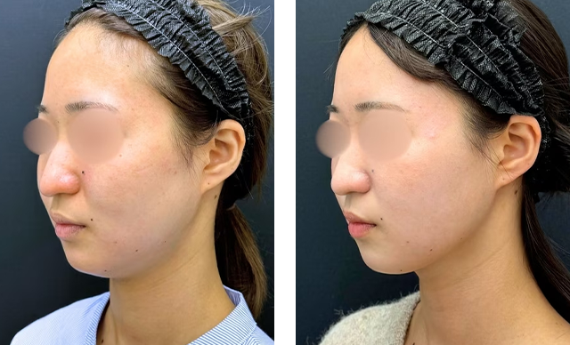 冨山尭弘医師｜美ボディ脂肪吸引｜施術前後の症例写真
