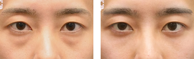上田将士医師｜目の下の切らないクマ・たるみ（ふくらみ）取り、ナチュラル脂肪注射コンデンスリッチ｜施術前後の症例写真