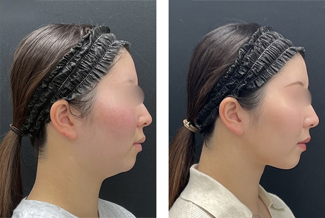 加藤重磨医師｜小顔用脂肪吸引注射｜施術前後の症例写真