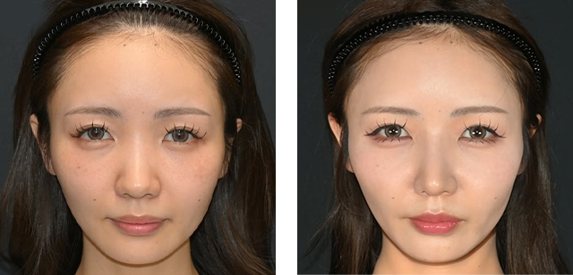 中野達生医師｜鼻尖形成/鼻尖形成3D法（だんご鼻解消術）、SBCナチュラルフィットプロテーゼ、鼻中隔延長術（鼻中隔軟骨）｜施術前後の症例写真