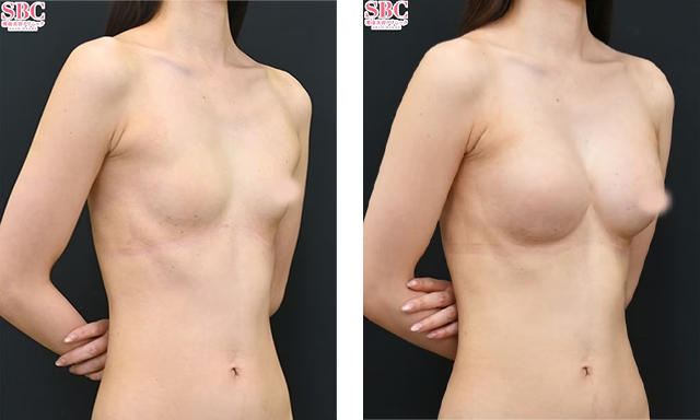 山本高士医師｜エルゴノミクス2＋コンデンスハイブリッド、メリハリバストセット（副乳・脇肉吸引）｜施術前後の症例写真