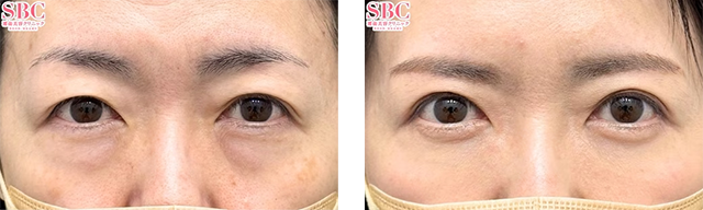 松阪佑介医師｜切開ハムラ(表ハムラ)法、眉下リフト（眉下切開）｜施術前後の症例写真