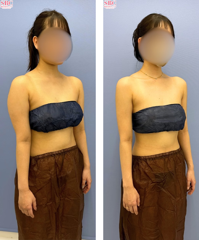 葛島魁人医師|根こそぎVASER脂肪吸引、Aquicell(アキーセル)脂肪吸引、エンブレイスRF|施術前後の症例写真