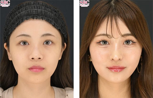 居川和広医師|鼻中隔延長術(肋軟骨)、鼻尖形成/鼻尖形成3D法(だんご鼻解消術)、小鼻縮小(内側法+締め付け縫合)|施術前後の症例写真
