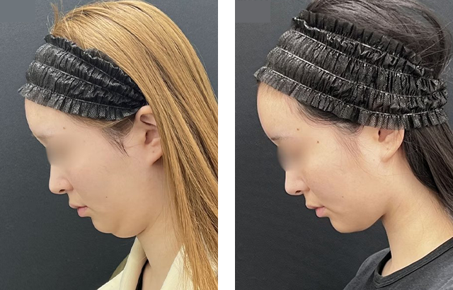加藤重磨医師｜小顔用脂肪吸引注射｜施術前後の症例写真