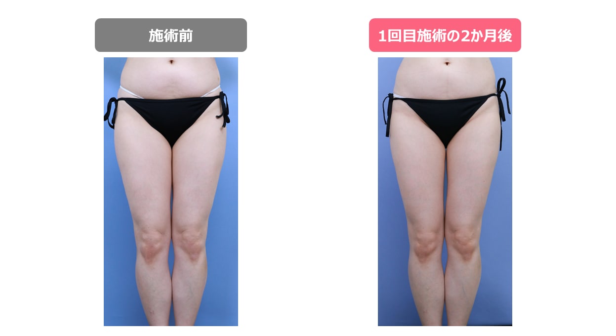 クールスカルプティングのリスクは何ですか?