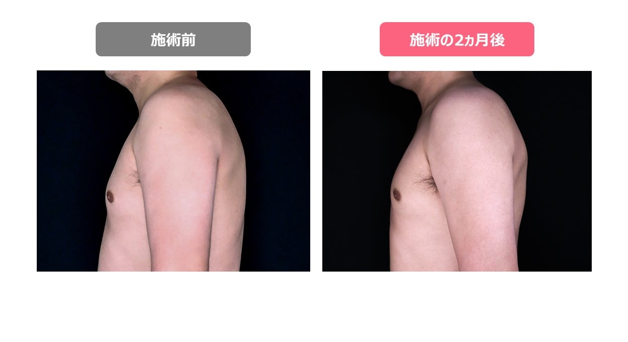 症例あり 男性でもクールスカルプティング クルスカ は受けられる 施術を受ける男性の悩みを紹介 医療ダイエット 医療痩身のお役立ちブログ