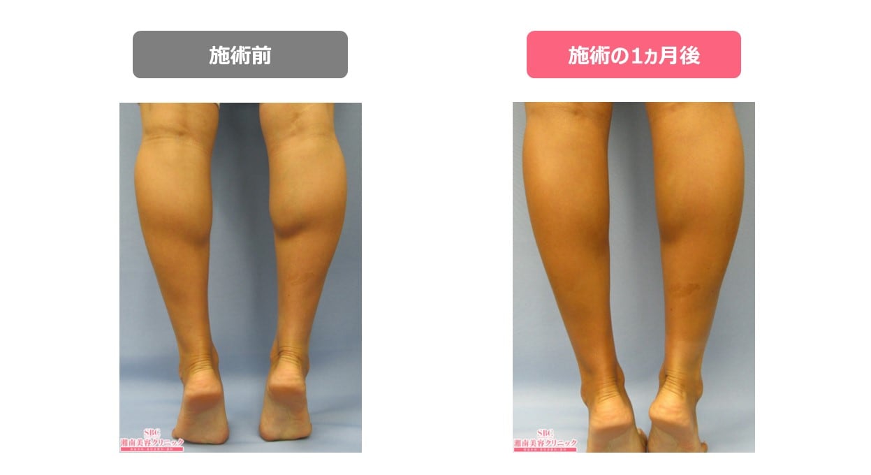 症例あり ふくらはぎの部分痩せをするには きれいな脚を目指す方法をご紹介 医療ダイエット 医療痩身のお役立ちブログ