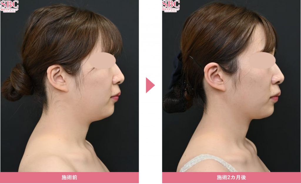 下膨れ顔が気になる...原因とスッキリさせる解消方法を徹底解説! | 医療ダイエット・医療痩身のお役立ちブログ