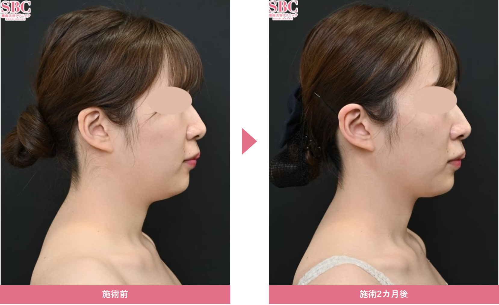 クルスカダブルの症例