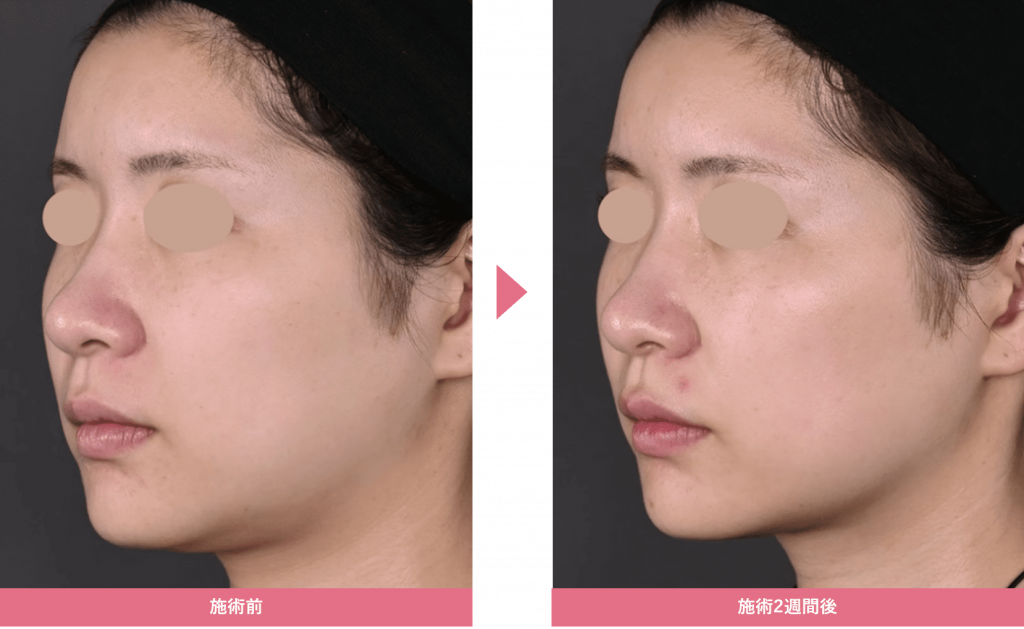 下膨れ顔が気になる...原因とスッキリさせる解消方法を徹底解説! | 医療ダイエット・医療痩身のお役立ちブログ