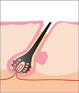 毛を剃った状態の皮膚断面図