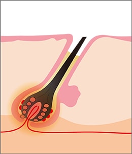 毛を生やす機能を破壊