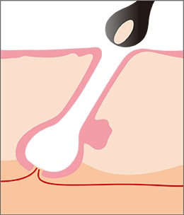 毛を生やす機能を破壊されたことにより、毛は成長せずに生えてこなくなる