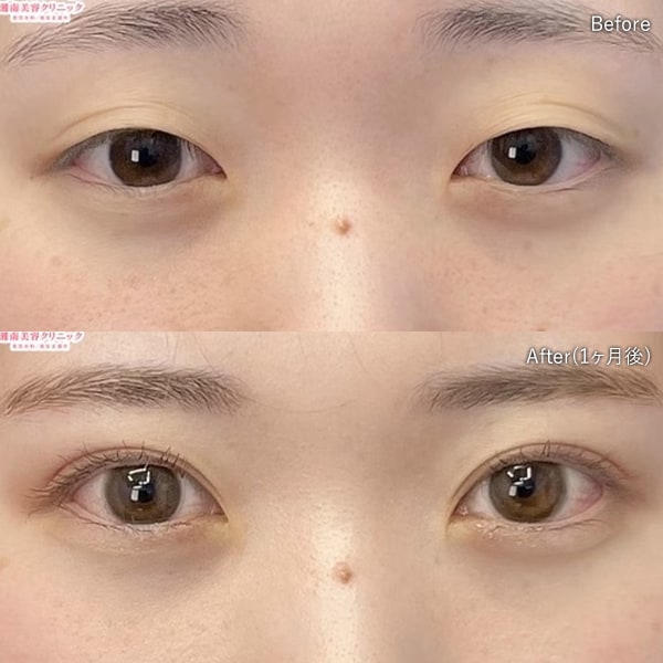 二重・二重整形