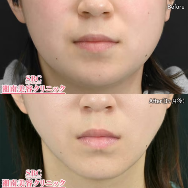 フェイスライン