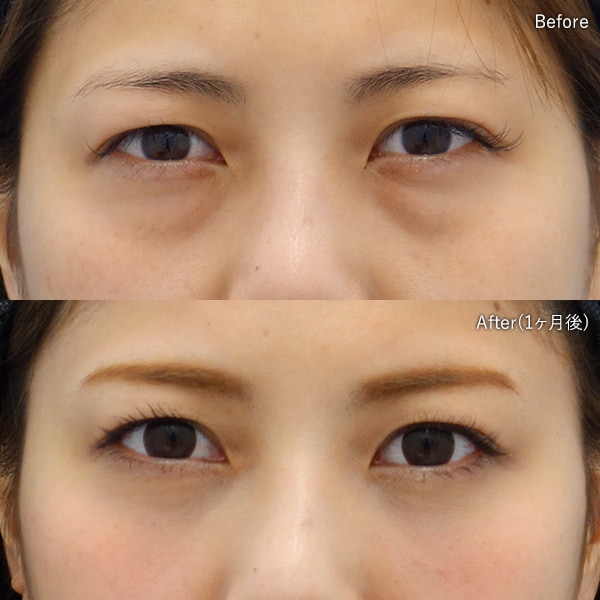 目の下の切らないクマ取り・たるみ(ふくらみ)取り